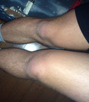 Dowdy's blown knee
